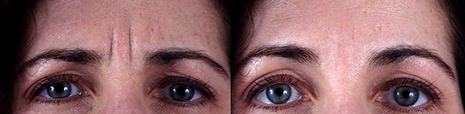 Фото пациента до и после ботокс (botox)