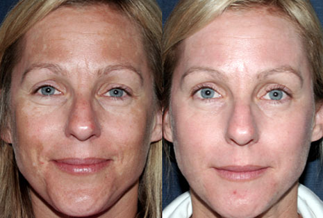 Фотография пациента до и после процедуры Фраксель (Fraxel)