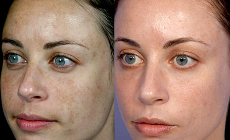 Фотография пациента до и после процедуры Фраксель (Fraxel)
