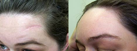 Фото до и после лечения шрамов и рубцов