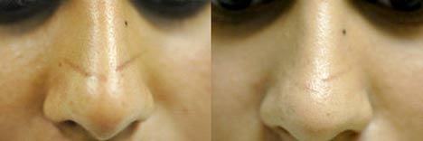 Фото до и после лечения шрамов и рубцов