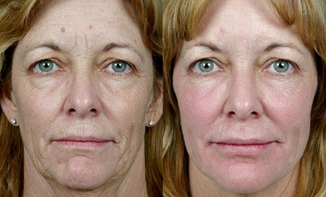 Фотография пациента до и после процедуры
