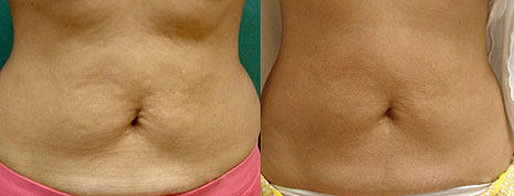 Фотографии пациентов до и после процедуры Термаж по телу