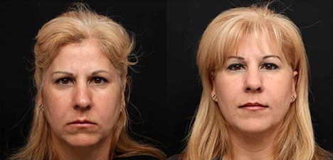Фотография пациента до и после процедуры плазмотерапии